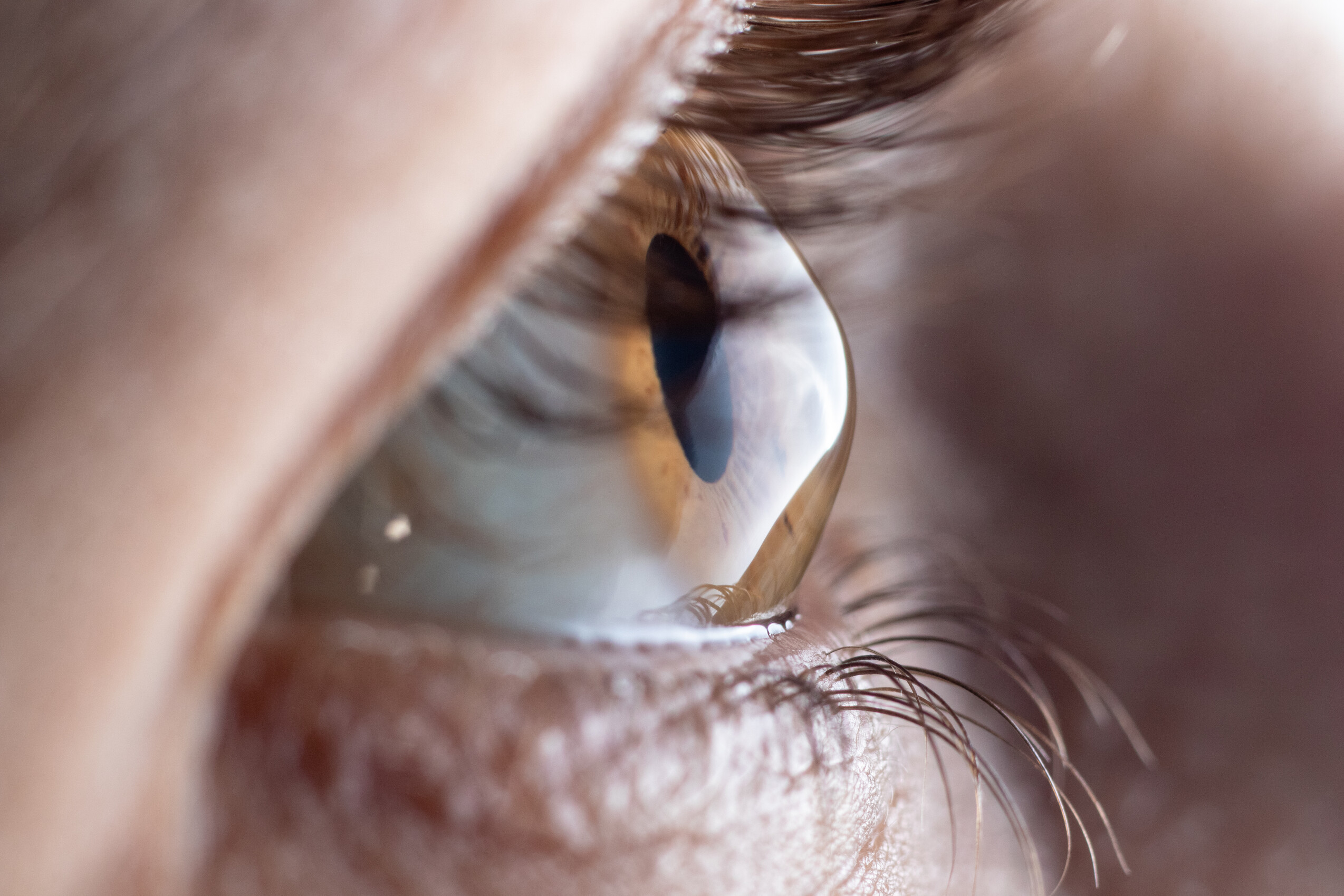 Keratoconus eye disease thinning cornea form cone